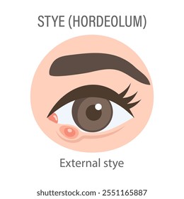 Estilo externo del ojo. Concepto médico de orzuelo, dolor ocular, infección bacteriana, enfermedad ocular. Ilustración plana, Anuncio de infografía