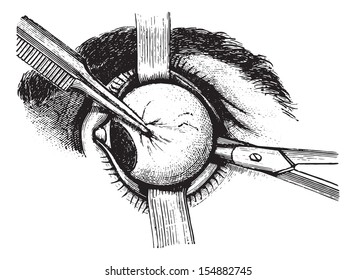 Extirpation of the eye, vintage engraved illustration. Usual Medicine Dictionary - Paul Labarthe - 1885.