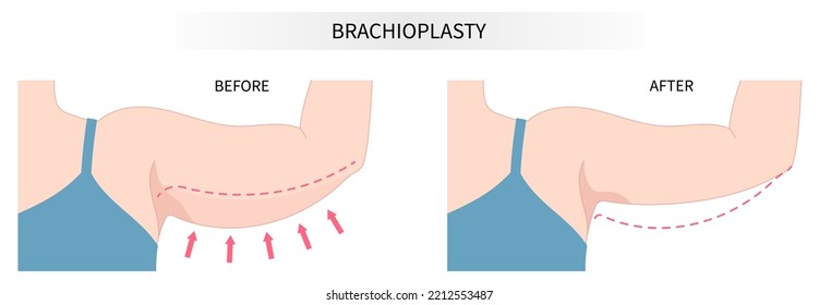 extra skin reducing with brachioplasty Remove contouring