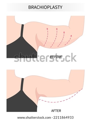 extra skin reducing with brachioplasty Remove contouring