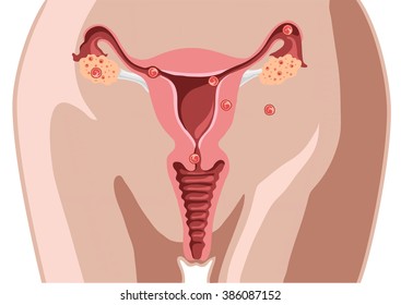 Extra uterine (ectopic) pregnancy all type