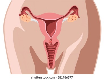 Extra uterine (ectopic) pregnancy - tubal pregnancy
