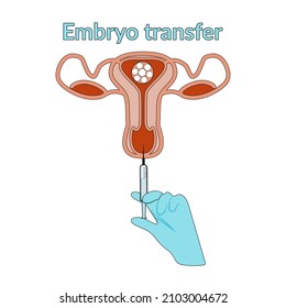 Extracorporeal fertilization in flat and hand-drawn style. Artificial insemination diagram. Transfer of the fertilized egg into the uterus. Embryo transfer. Vector illustration for a science textbook