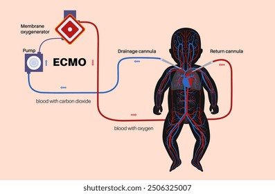 Extracorporeal membrane oxygenation. ECMO infant. Extracorporeal life support, heart lung machine. Mechanical circulatory support. Blood circulation in the human baby body flat vector illustration