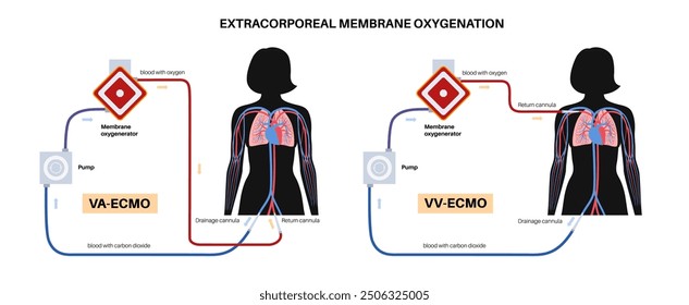Extracorporeal membrane oxygenation. VA and VV ECMO. Extracorporeal life support, heart lung machine. Mechanical circulatory support system. Blood circulation in the female body vector illustration