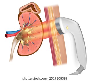 Extracorporeal shock wave lithotripsy or ESWL. Treatment kidney stones. Wave lithotripsy therapy. 