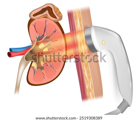Extracorporeal shock wave lithotripsy or ESWL. Treatment kidney stones. Wave lithotripsy therapy. 