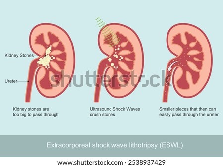 Extracorporeal shock wave lithotripsy (ESWL) for kidney stones. shock waves to break a kidney stone into small pieces that can more easily travel through the urinary tract and pass from the body.