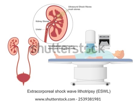 Extracorporeal shock wave lithotripsy ESWL is a common nonsurgical procedure to treat kidney stones.It uses high-energy shock (pressure)waves to break up stones.Medical healthcare vector illustration
