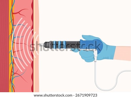 Extracorporeal Shock Wave Therapy (ESWT) is a non-invasive medical treatment using high-energy acoustic waves to break down tissue or promote healing in chronic musculoskeletal conditions.