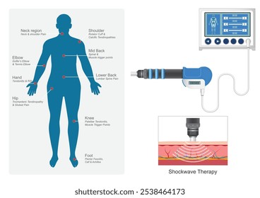 Condición del tratamiento de la terapia de onda de choque extracorpórea. Promueve el alivio del dolor, la recuperación muscular y la salud de la columna vertebral. (ESWT para abreviar) Atención médica, Ilustración vectorial.