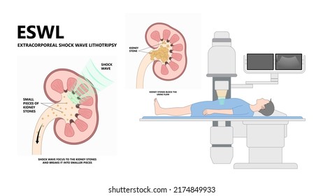 Extracorporeal Shockwave Lithotripsy ESWL Kidney Stone Treatment Urinary Tract Renal Calculi Treat Diagnostic Exam Blood Urea Nitrogen BUN Percutaneous Nephrolithotomy Ureteral