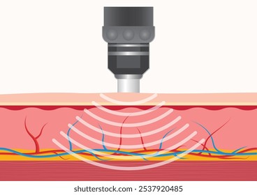 A terapia de onda de choque extracorpórea (ESWT) trata tendinite crônica, fasciite plantar e tendinite de Aquiles, entre outras doenças, assistência médica.