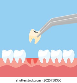 Extracted Tooth Decay Pull Out Sick Tooth