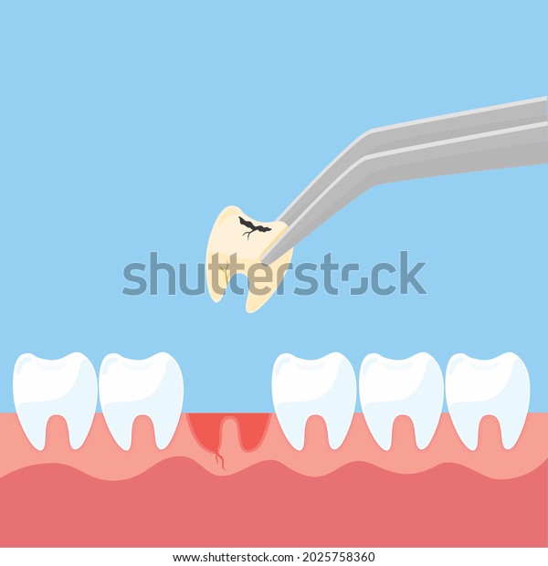 Extracted tooth decay
pull out sick tooth