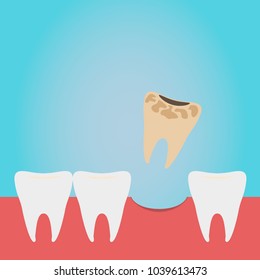 Extracted tooth in tongs. Dentist pulls out sick tooth. Stamatologic concept. Remove root. Vector illustration flat design. Isolated on background