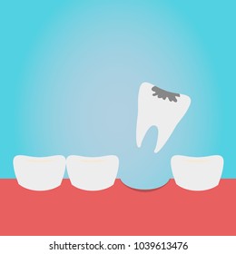 Extracted tooth in tongs. Dentist pulls out sick tooth. Stamatologic concept. Remove root. Vector illustration flat design. Isolated on background