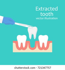 Extracted tooth in tongs. Dentist pulls out sick tooth. Stamatologic concept. Remove root. Vector illustration flat design. Isolated on background. Tweezers in hands.