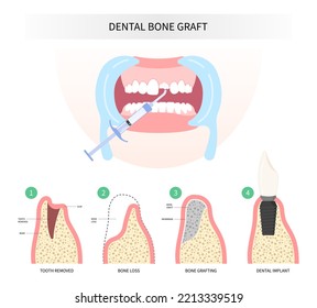 extraction Procedure of Teeth bone Graft surgery