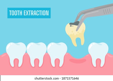 Extraction of teeth. Cartoon yellow teeth with tartar and plaque removed from the oral cavity.