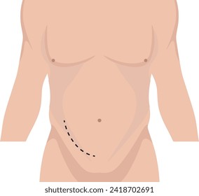 extraperitoneal laparoscopic kidney transplantation scar