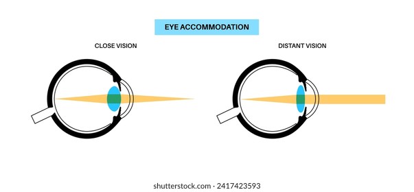 Augenunterkunft Infografik. Retina und Sklera, Ziliarmuskeln sind kontrahiert und entspannt, gerundet und flach. Objekte mit unterschiedlichen Entfernungen und klare Bilder, Vektorgrafik