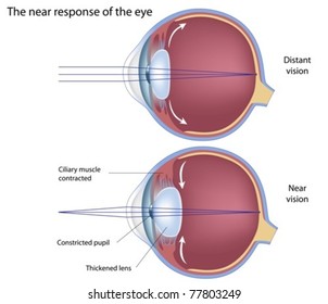 Eye adaptation to near vision