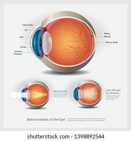 Eye Anatomy with Eye Abnormalities Vector Illustration