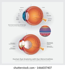 Eye Anatomy with Eye Abnormalities Vector Illustration