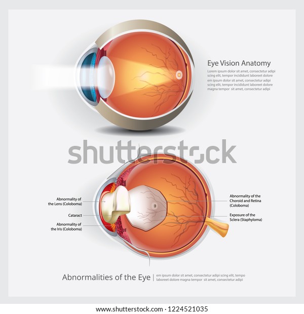 Eye Anatomy Eye Abnormalities Vector Illustration Stock Vector (Royalty ...