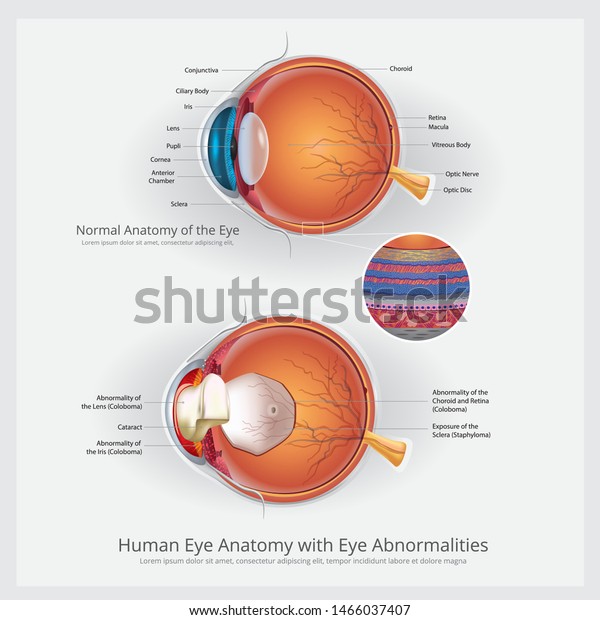 Eye Anatomy Eye Abnormalities Vector Illustration Stock Vector (Royalty ...