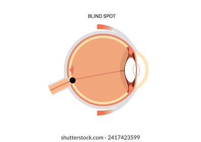 Eye anatomy and blind spot, optic disc anatomical poster. Scotoma infographic banner. Place in the retina where the optic nerve connects. One kind of optical illusion medical flat vector illustration