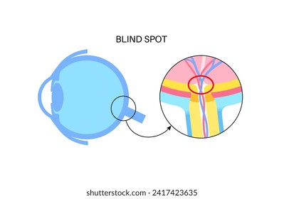 Eye anatomy and blind spot, optic disc anatomical poster. Scotoma infographic banner. Place in the retina where the optic nerve connects. One kind of optical illusion medical flat vector illustration