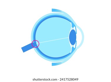 Eye anatomy and blind spot, optic disc anatomical poster. Scotoma infographic banner. Place in the retina where the optic nerve connects. One kind of optical illusion medical flat vector illustration