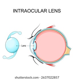 Eye anatomy. Cross-Section of human Eye. Close-up of Intraocular Lens. IOL implant position and location. Schematic illustration. medical diagram. Detailed Vector poster. 