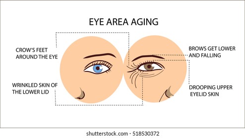 Eye area aging scheme. Eyes of young and old women with wrinkles and folds. 