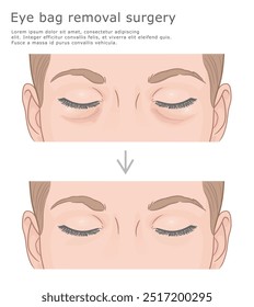 Eye bag removal surgery before and after vector illustration. Facelift medical illustration.