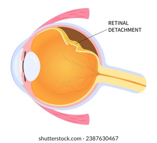 Eye blurred vision loss with floaters Myopia and detached retina after trauma injury of macular hole that tear or torn which lead to pain in nearsighted svg