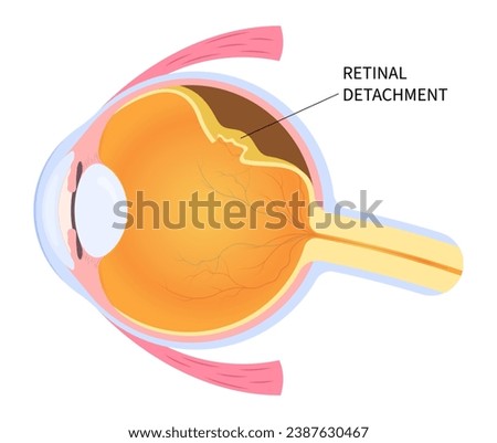 Eye blurred vision loss with floaters Myopia and detached retina after trauma injury of macular hole that tear or torn which lead to pain in nearsighted