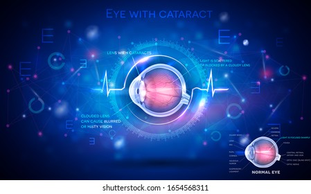 Eye with cataract, vision disorder and normal eye anatomy on an abstract blue scientific background, detailed info poster digital futuristic illustration.