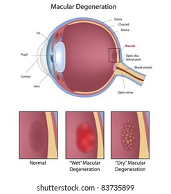 Eye Condition: Macular Degeneration