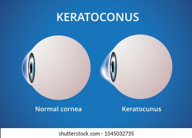 Eye cornea and keratoconus, eye disorder, medical illustration vector
