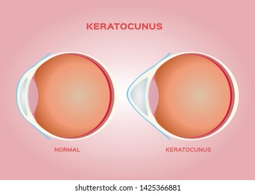 Eye Cornea And Keratoconus Vector / Anatomy