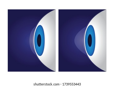 Eye Cornea And Keratoconus Vector / Anatomy