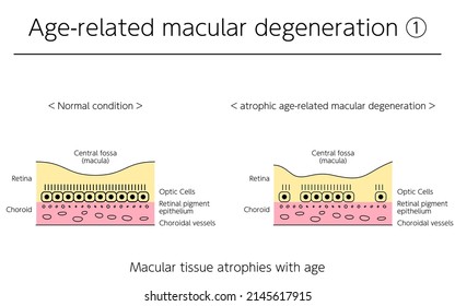 Eye Disease, Atrophic Age-Related Macular Degeneration Illustrated