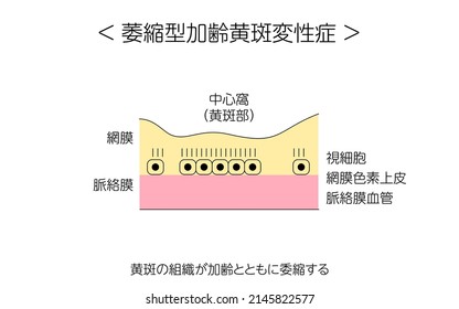 Eye Disease, Atrophic Age-Related Macular Degeneration Illustrated - Translation: normal state, atrophic age-related macular degeneration, atrophy of macular tissue with age, retina, choroid