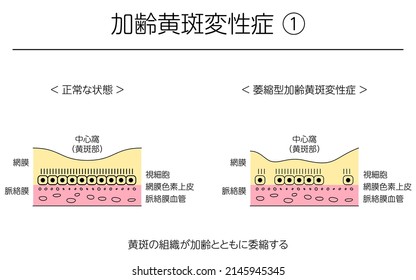 Eye Disease, Atrophic Age-Related Macular Degeneration Illustrated - Translation: normal state, atrophic age-related macular degeneration, atrophy of macular tissue with age, retina, choroid