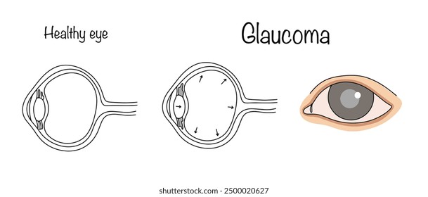 An eye disease caused by increased intraocular pressure. An eye with glaucoma. Ophthalmological disease. Vector illustration.