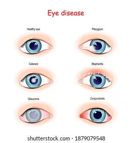 Eye disease. comparison and difference between Healthy eye, Conjunctivitis, Pterygium, Glaucoma, Cataract, and Blepharitis