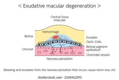 Eye Disease, Exudative Age-Related Macular Degeneration Illustrated